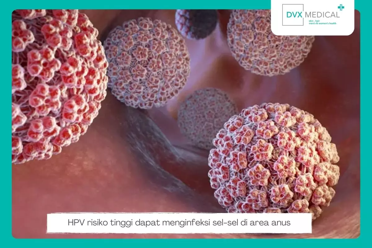 Bagaimana HPV Risiko Tinggi Menyebabkan Kanker Anus?