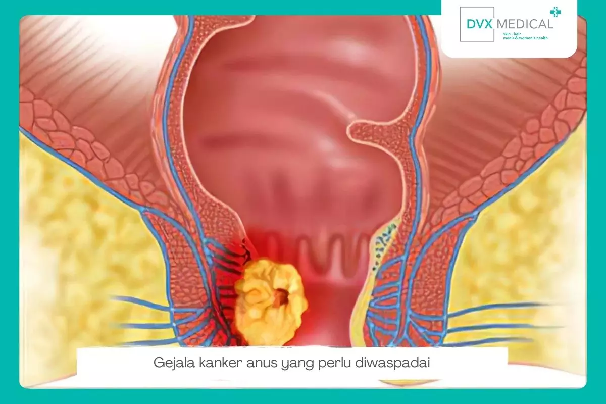 Gejala Awal Kanker Anus yang Disebabkan oleh HPV Risiko Tinggi