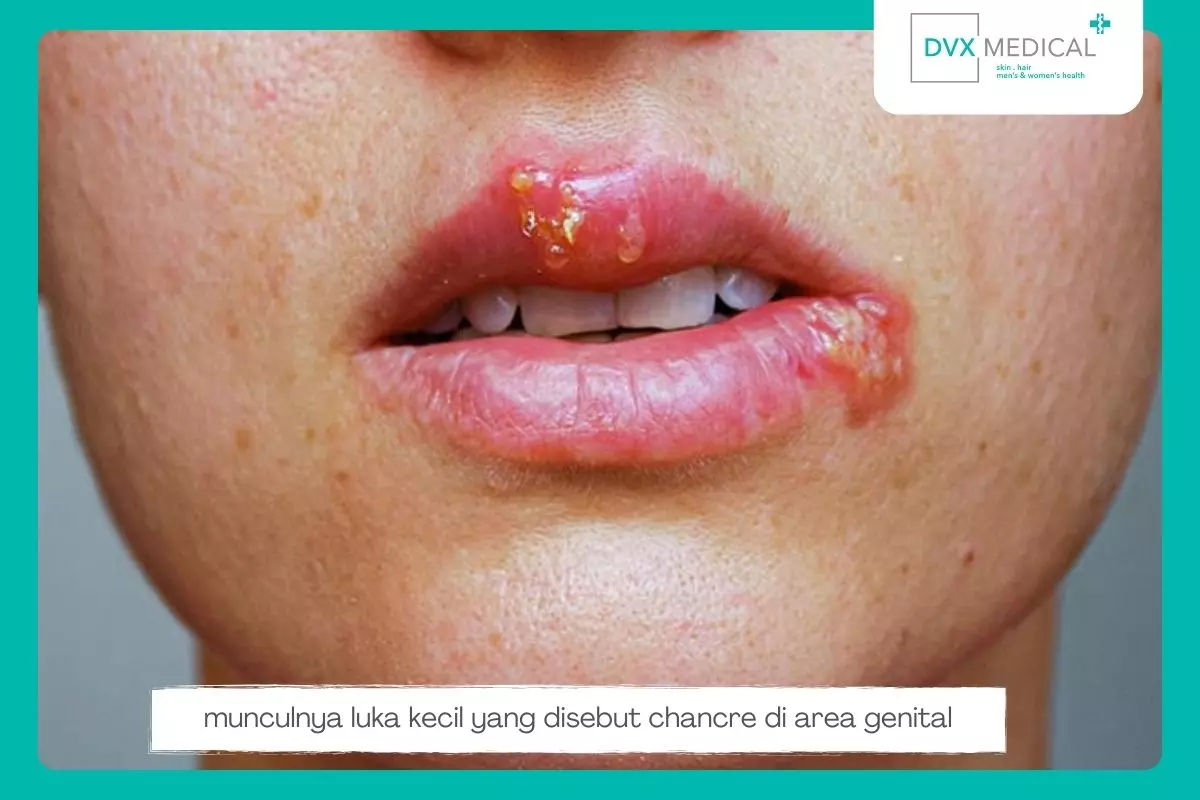 Step 1: Infeksi Awal dan Sifilis Primer