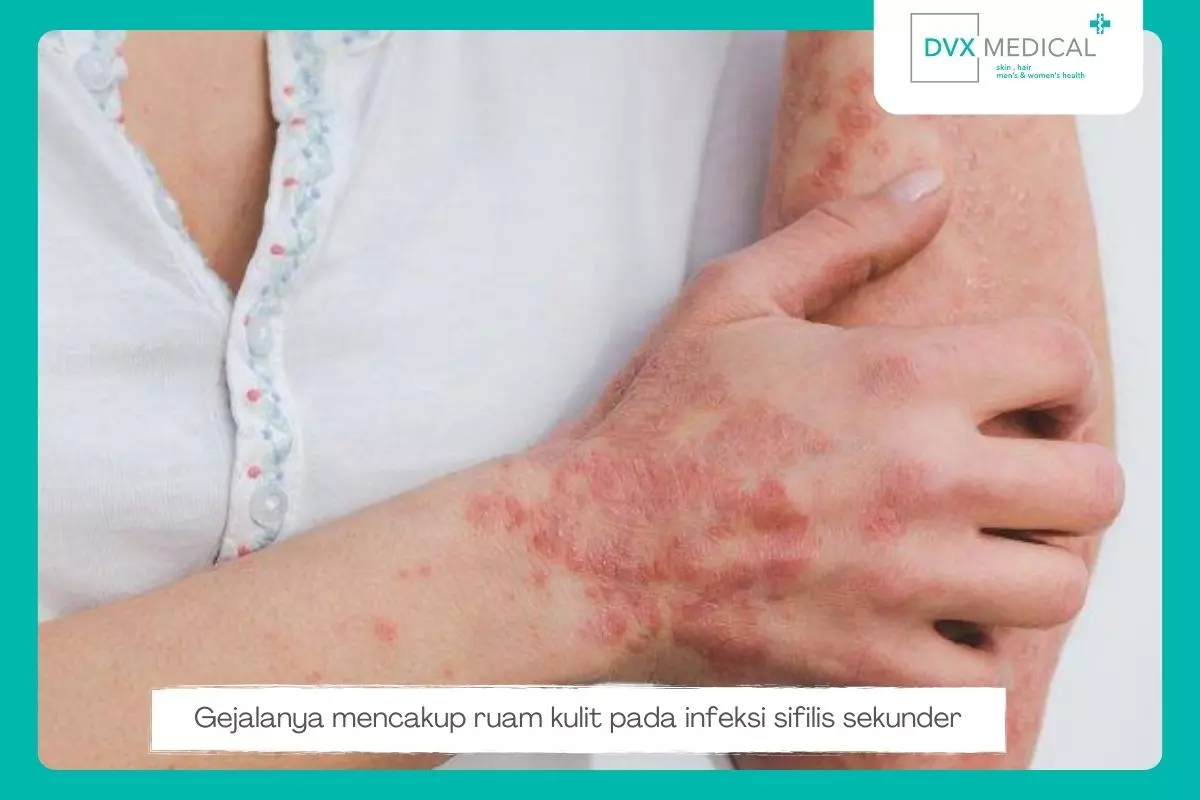 Step 2: Sifilis Sekunder