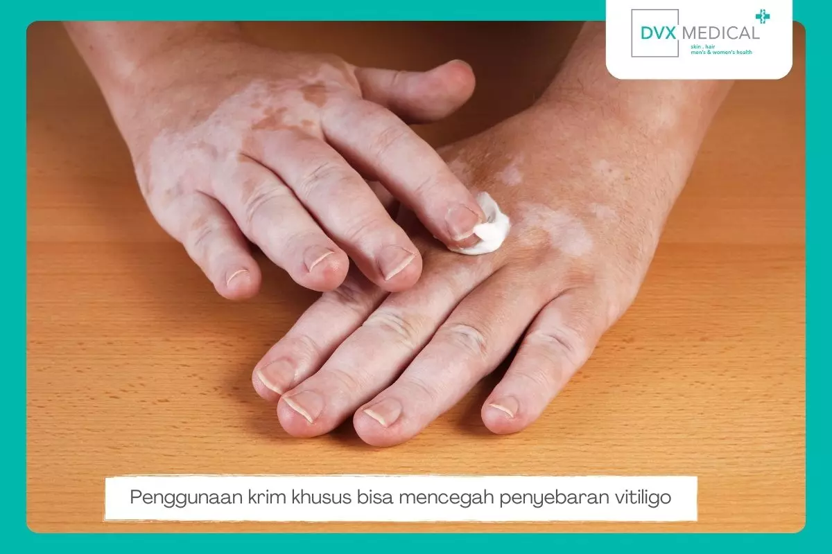 2. Gunakan Krim Topikal dan Obat Lainnya