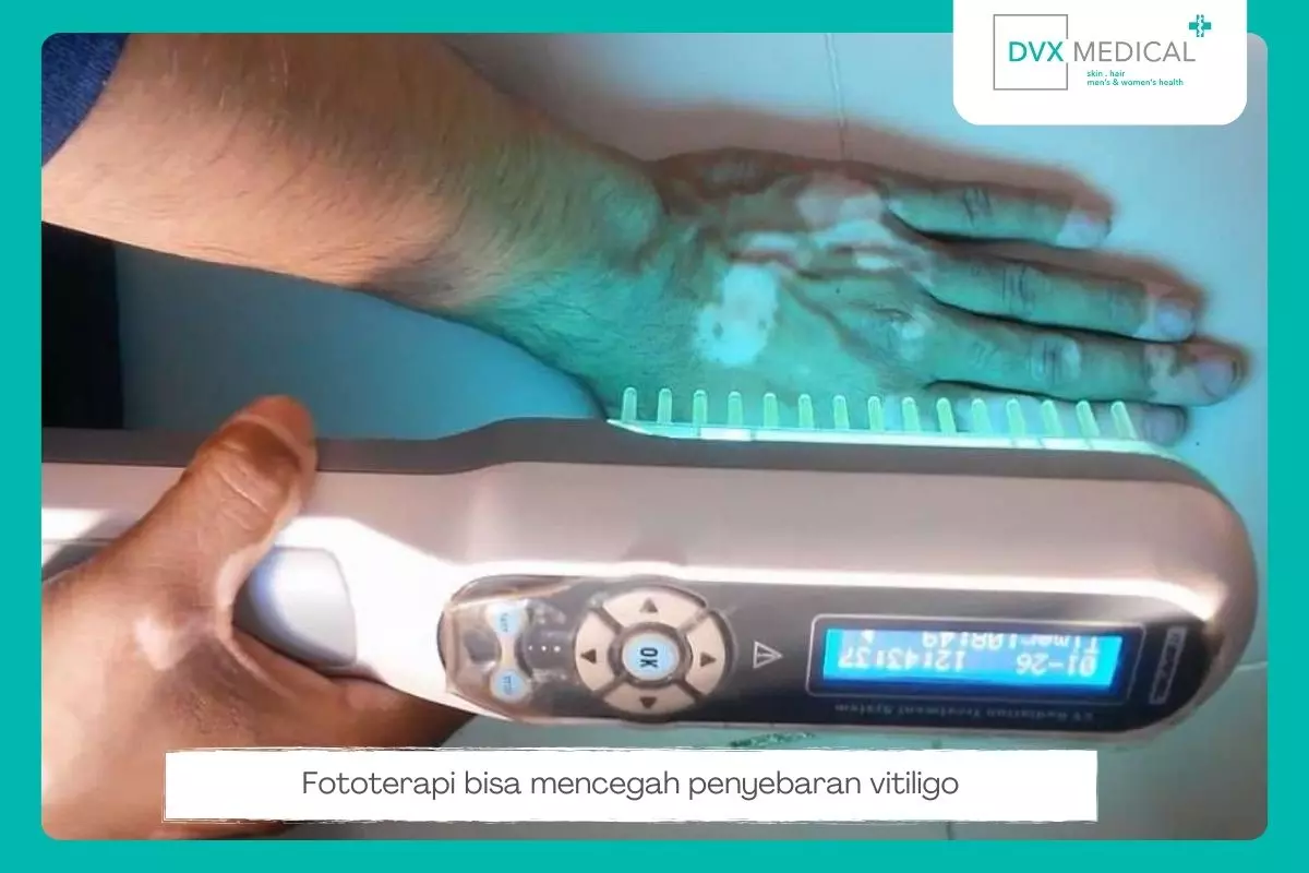 3. Lakukan Fototerapi (nbUVB)