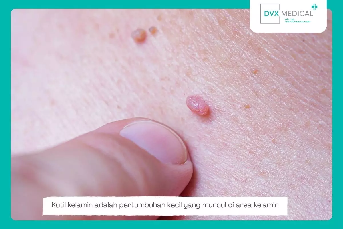 Apa Itu Kutil Kelamin?