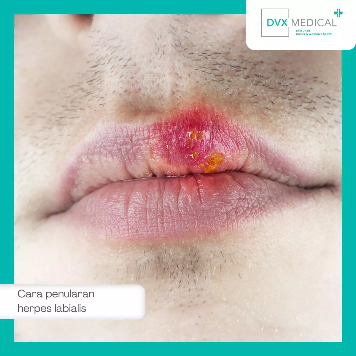 Penyebab dan Cara Penularan Herpes Labialis