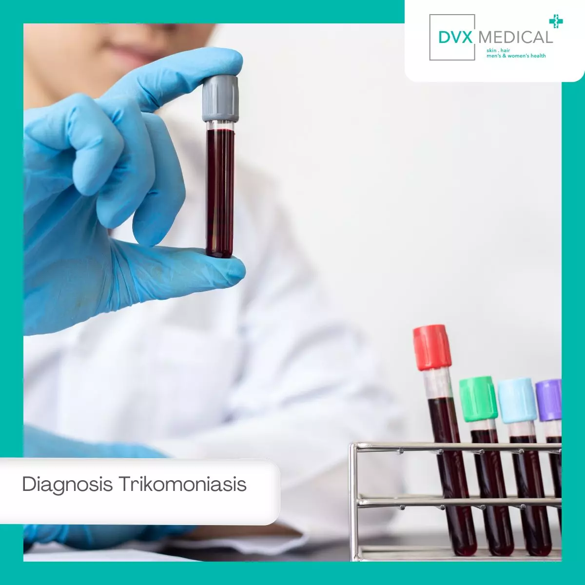 Diagnosis Trikomoniasis