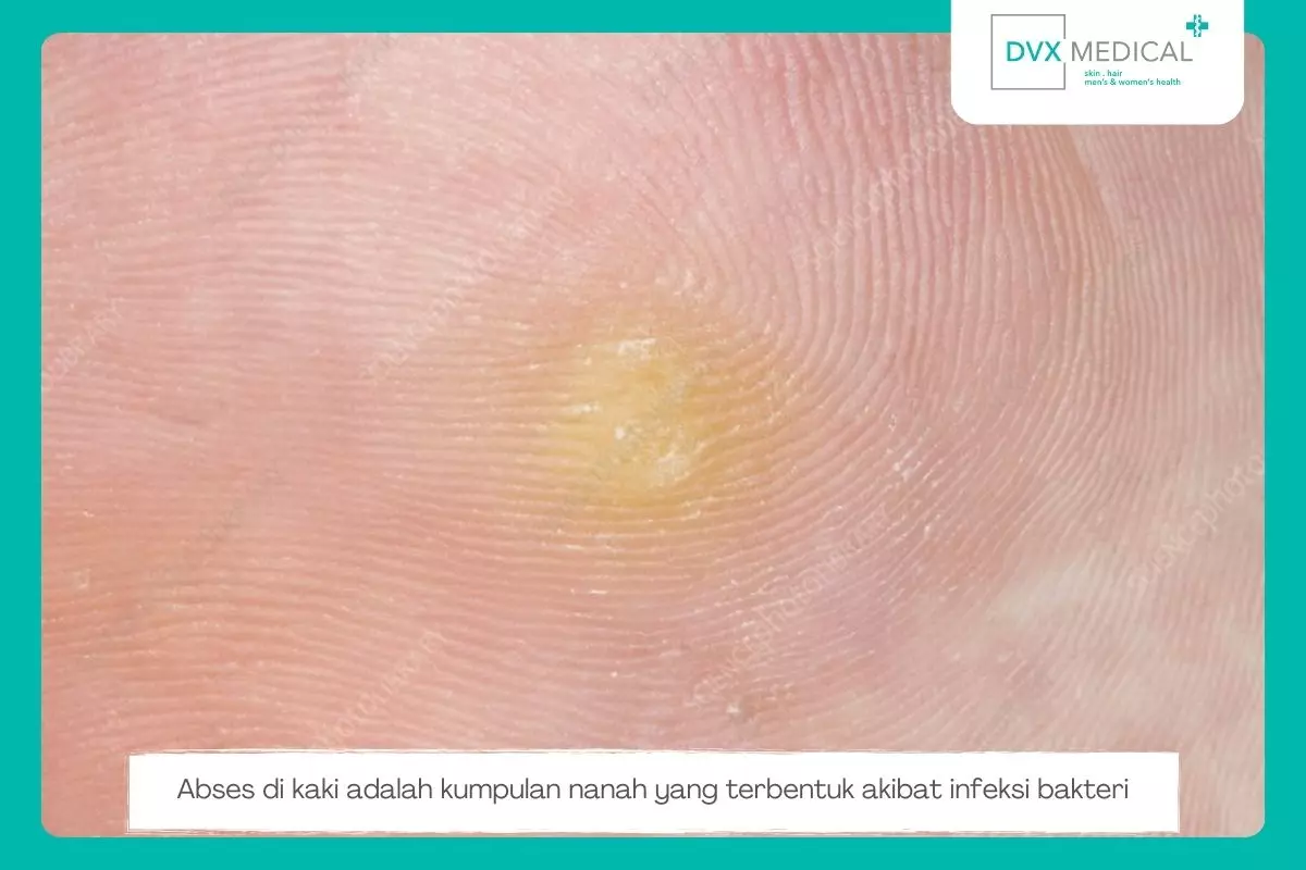 Apa Itu Abses di Telapak Kaki?
