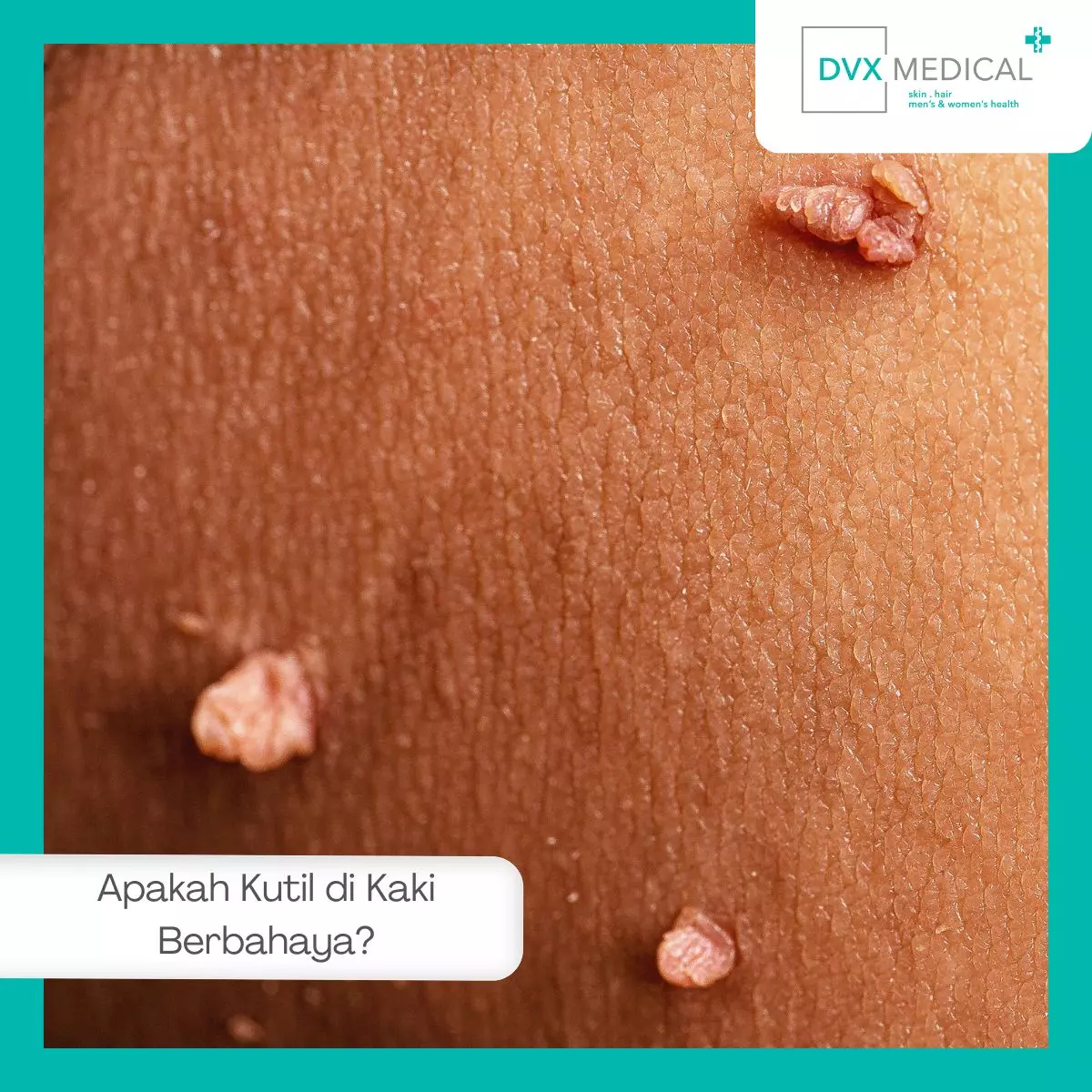 Apakah Kutil di Kaki Berbahaya?