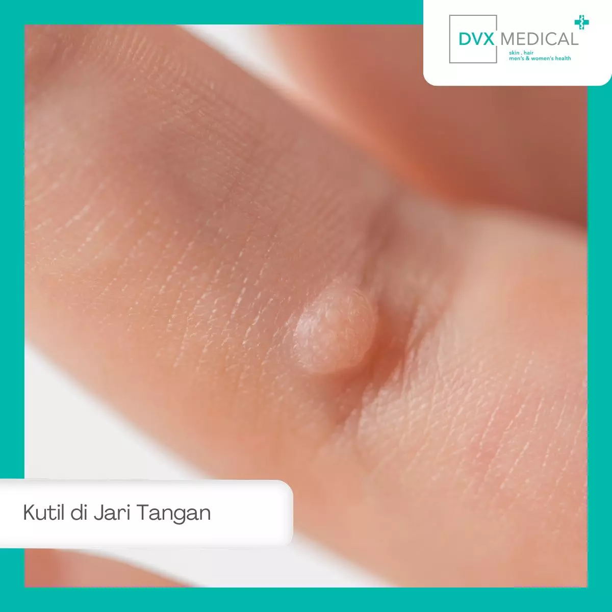 Penyebab Kutil di Jari Tangan