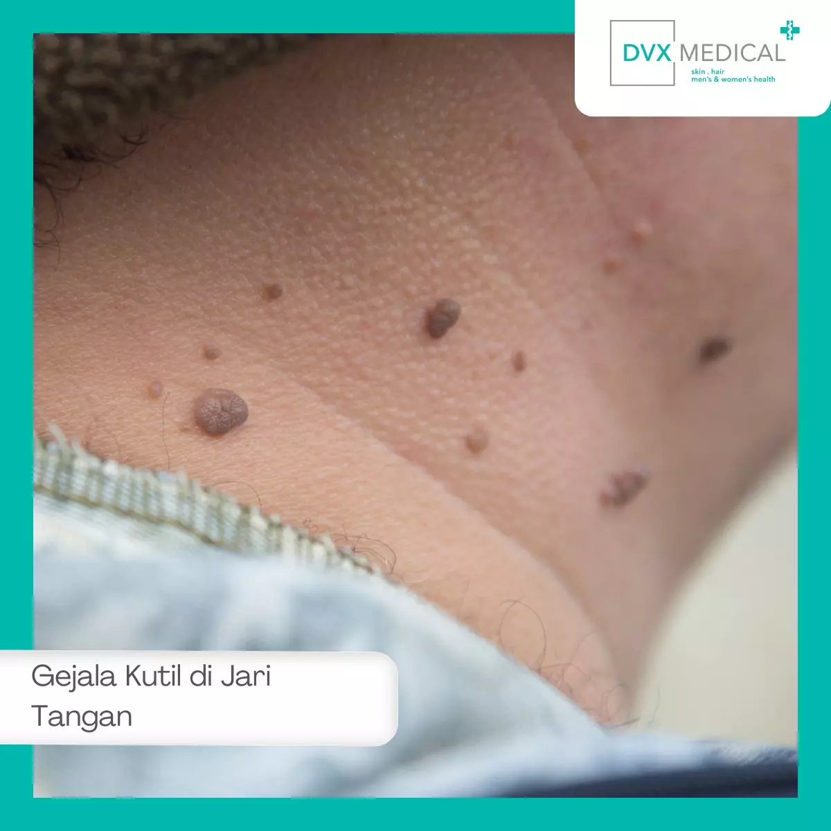 Gejala Kutil di Jari Tangan