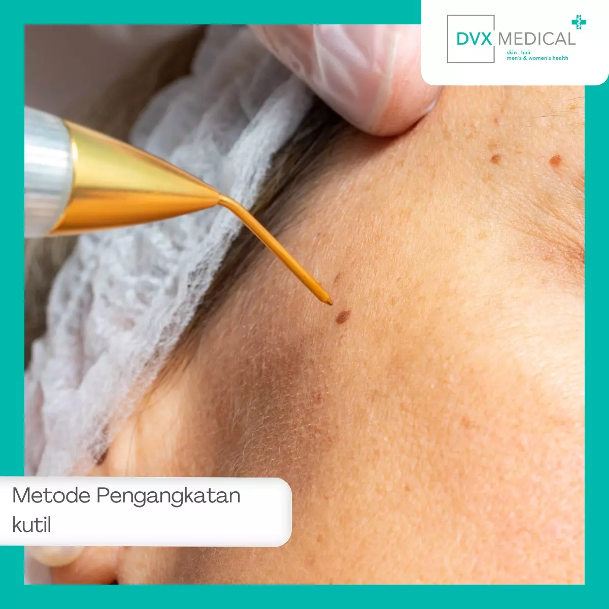 Metode Pengangkatan Kutil di DVX Medical Surabaya