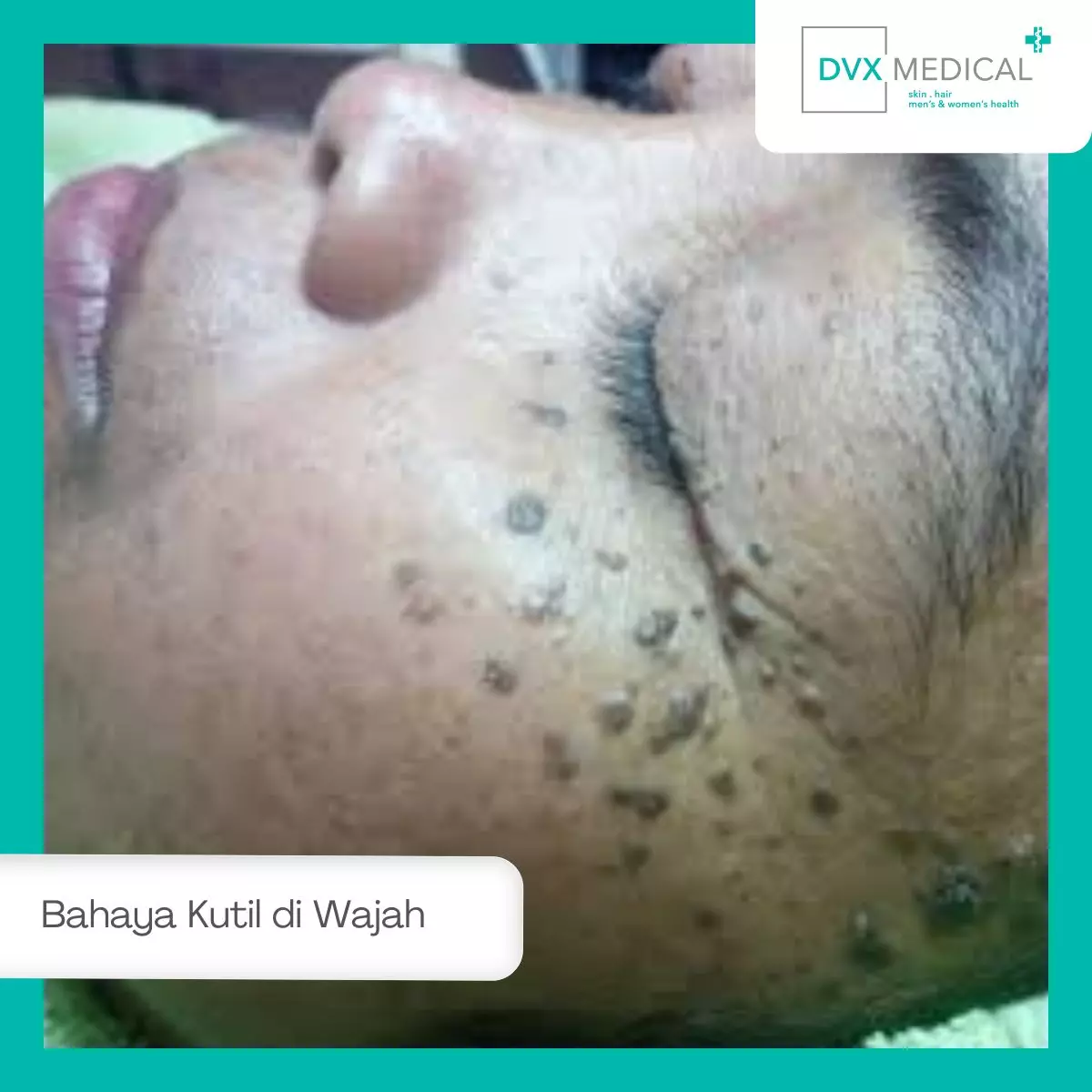 Bahaya Kutil di Wajah