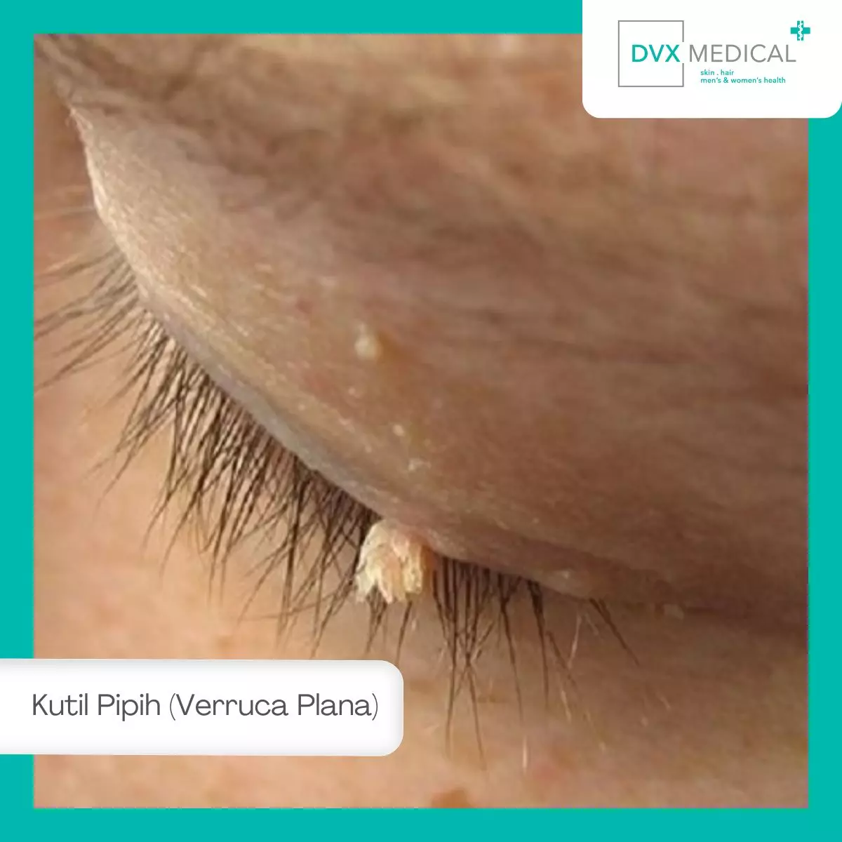 2. Kutil Pipih (Verruca Plana)