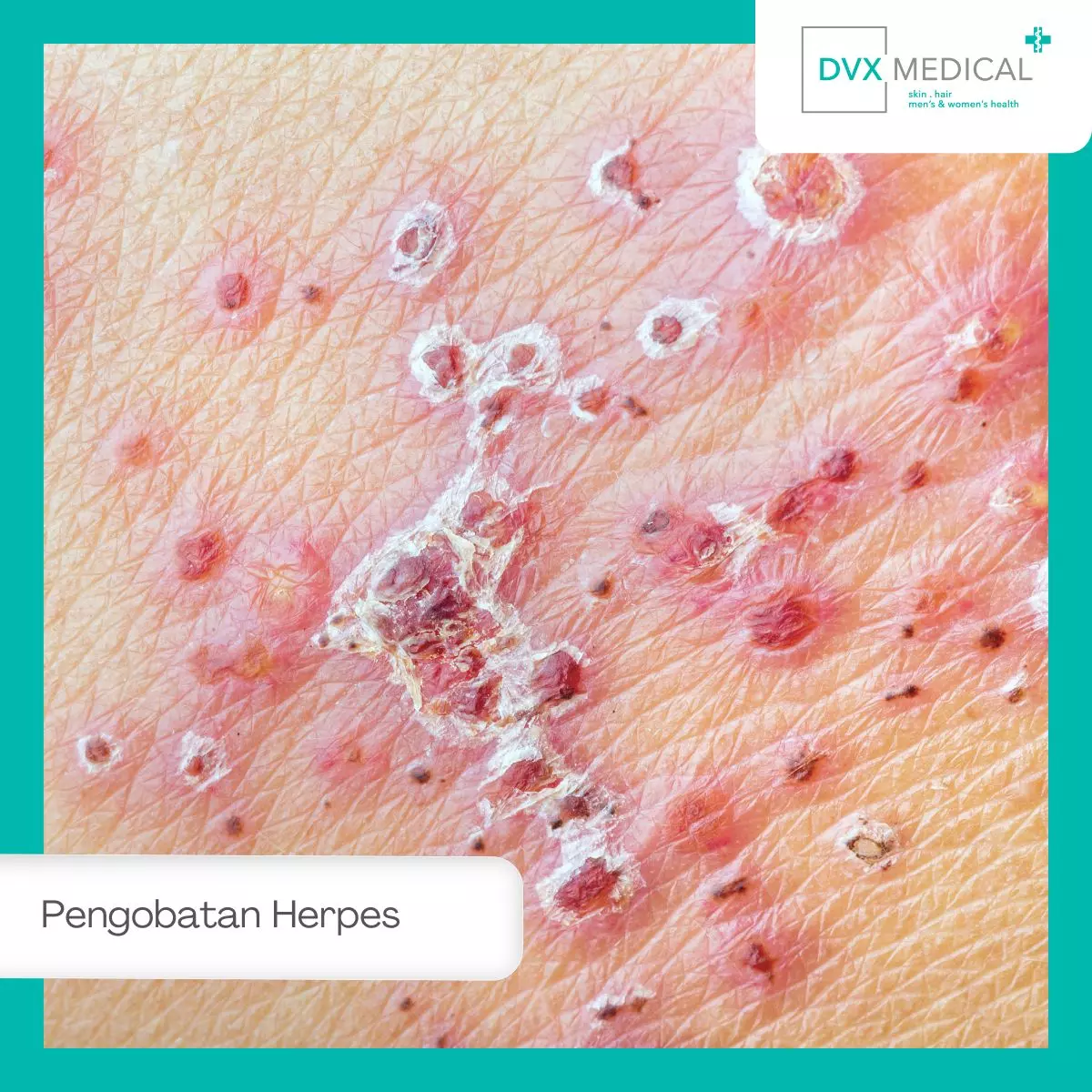Langkah-Langkah Pengobatan Herpes di DVX Medical Jakarta