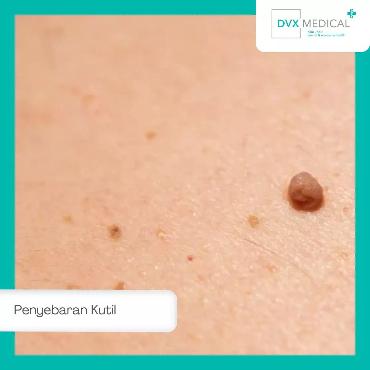 Komplikasi yang Bisa Terjadi