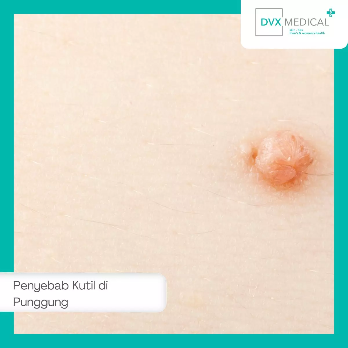 Penyebab Kutil di Punggung