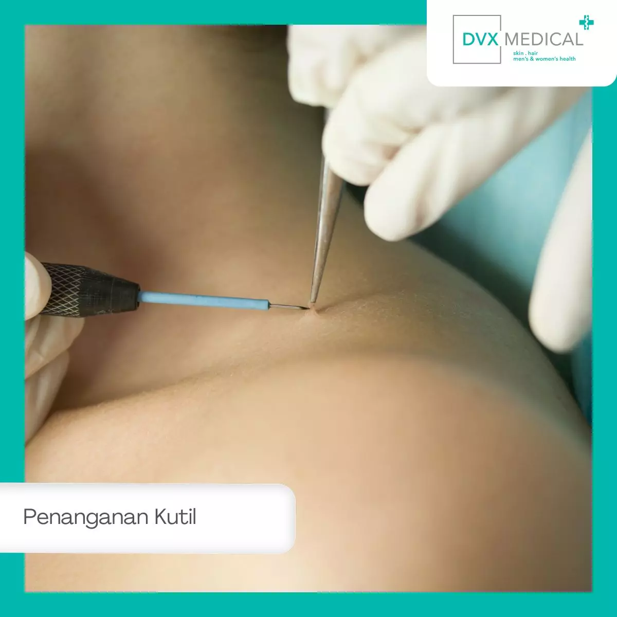 Penanganan Kutil Profesional di Klinik DVX Medical Surabaya