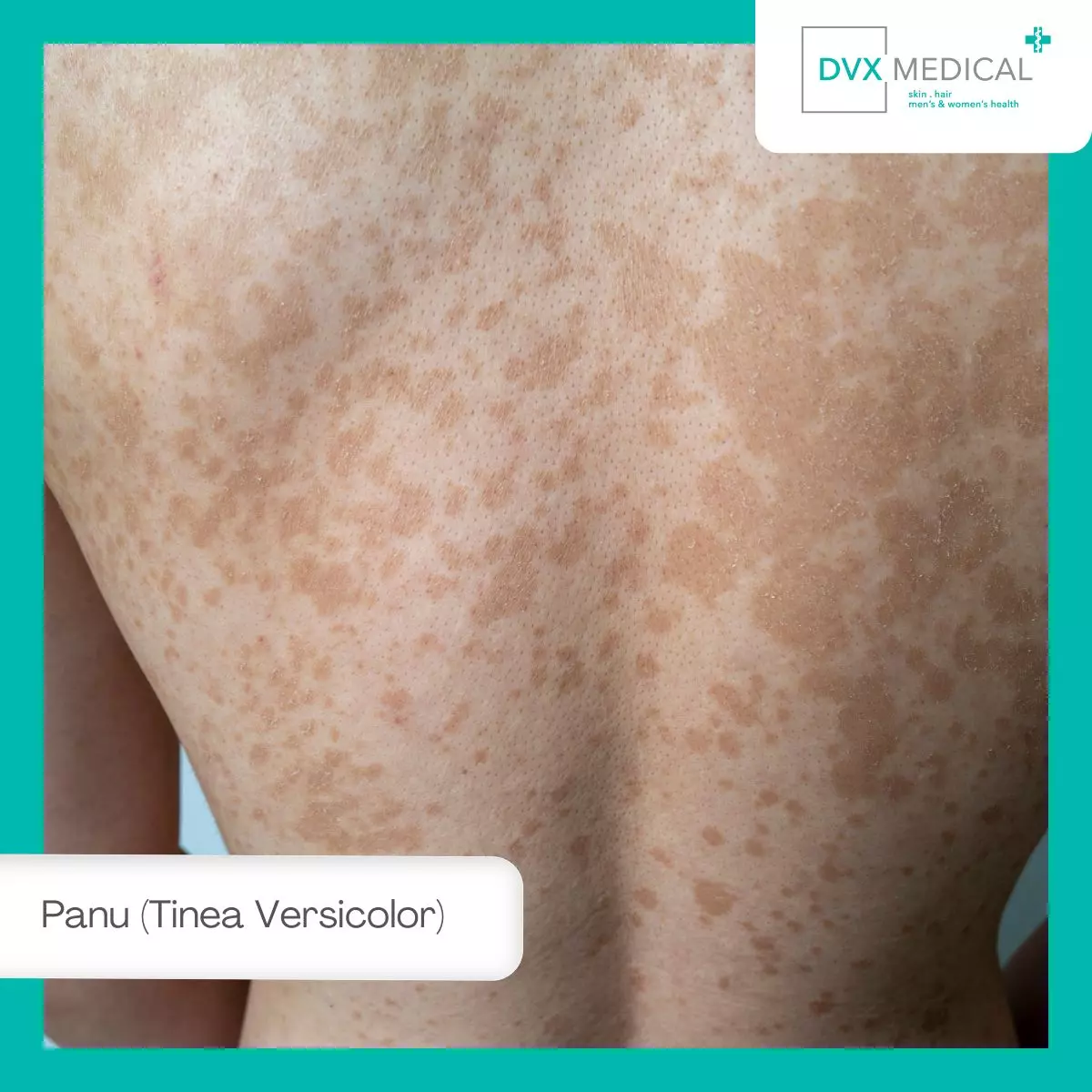 1. Panu (Tinea Versicolor)