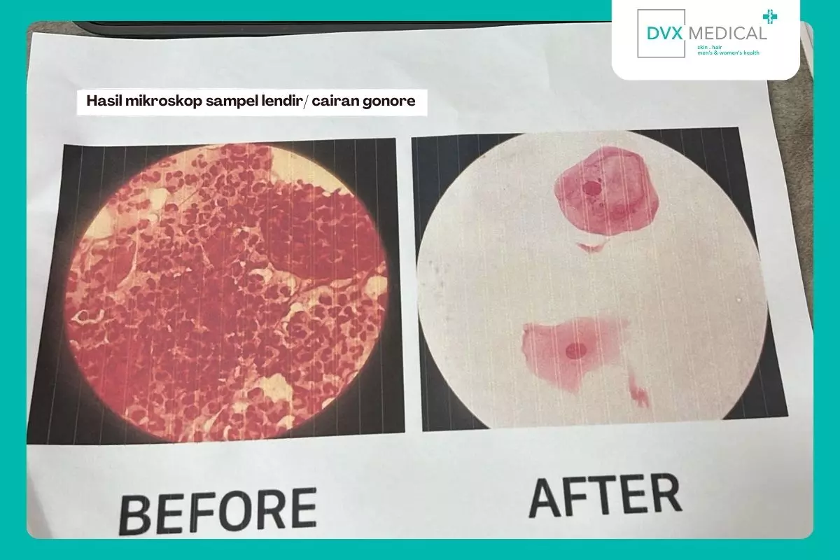 4. Manfaat Tes Lab Gonore di DVX Medical Surabaya