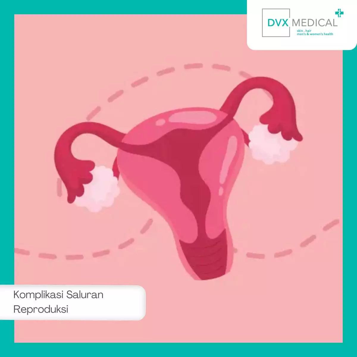 Komplikasi Chlamydia pada Reproduksi Wanita