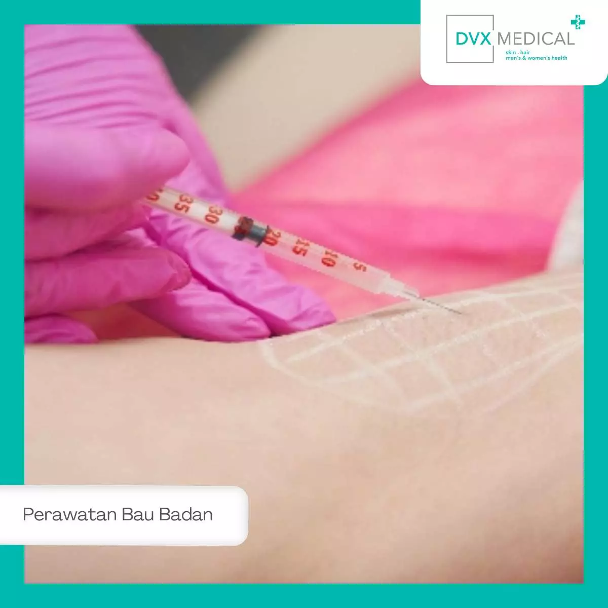 Teknologi Selain Botox dan Operasi untuk Bau Badan