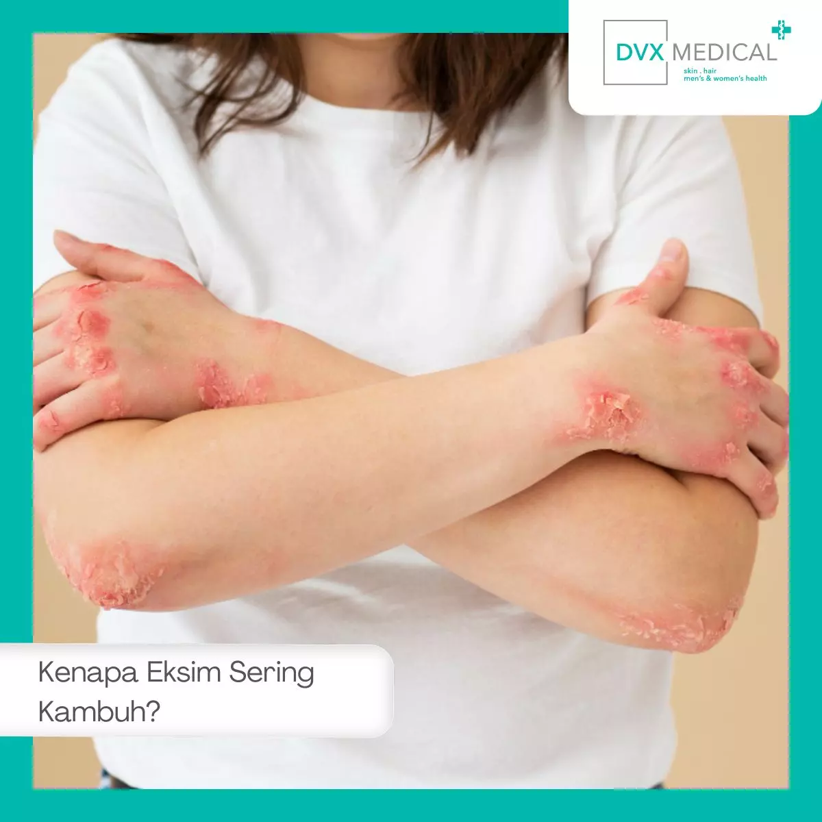 Kenapa Eksim Sering Kambuh?