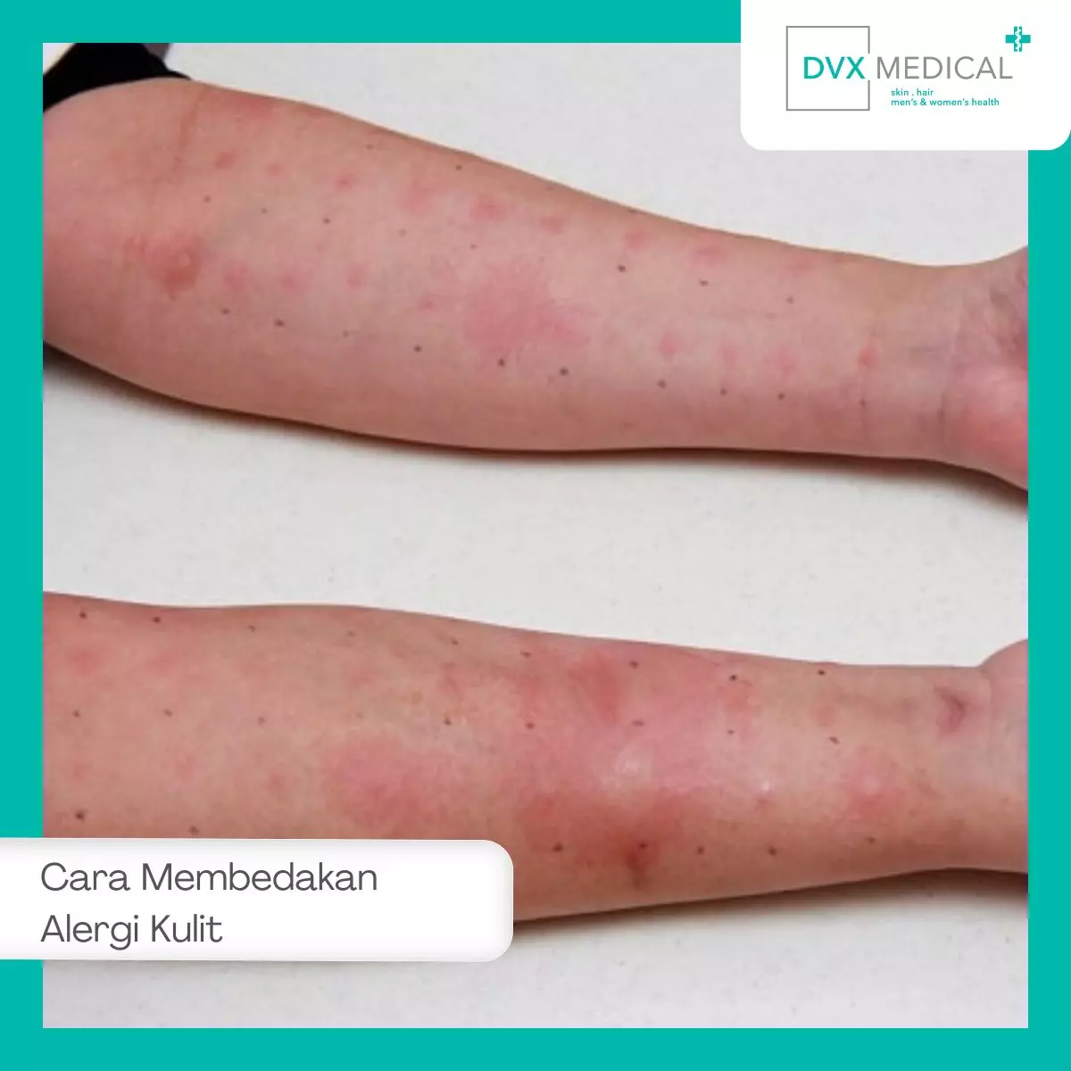 Cara Membedakan Alergi Kulit vs Masalah Kulit Lain