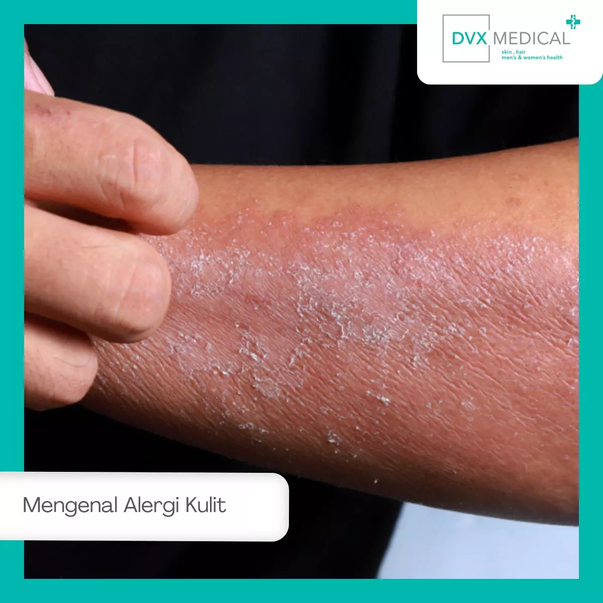 Mengenal Alergi Kulit dan Gejalanya