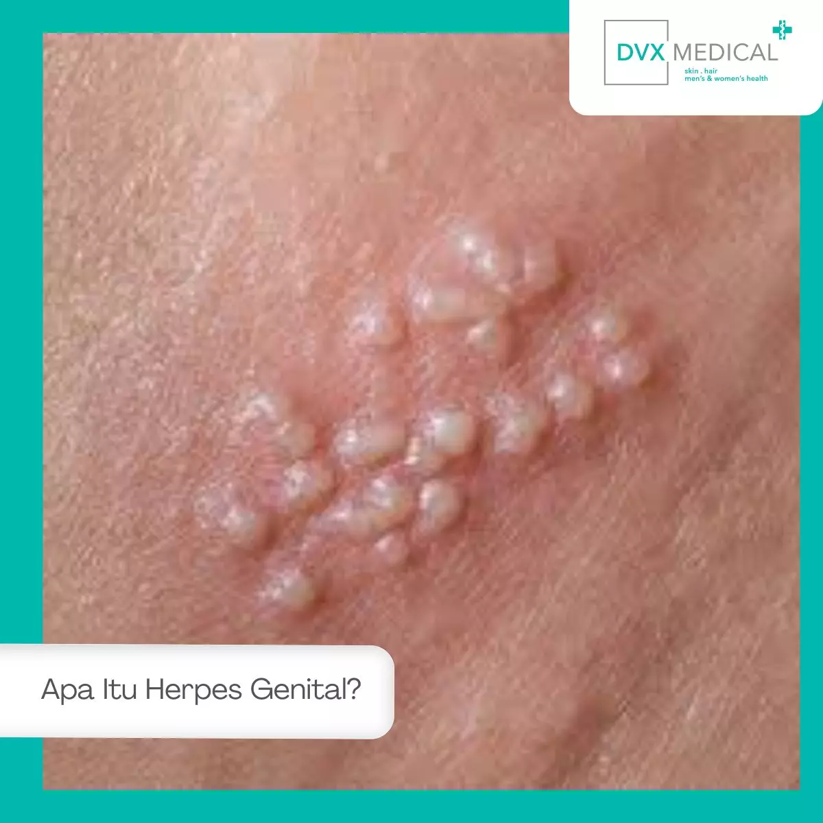 Apa Itu Herpes Genital?