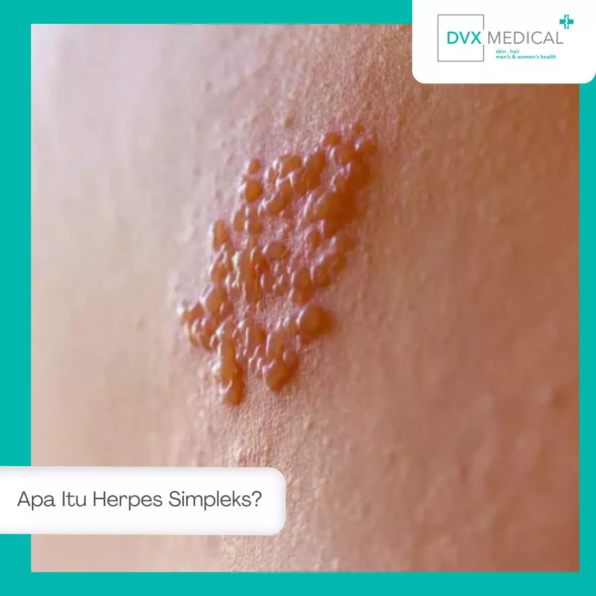 Apa Itu Herpes Simpleks?