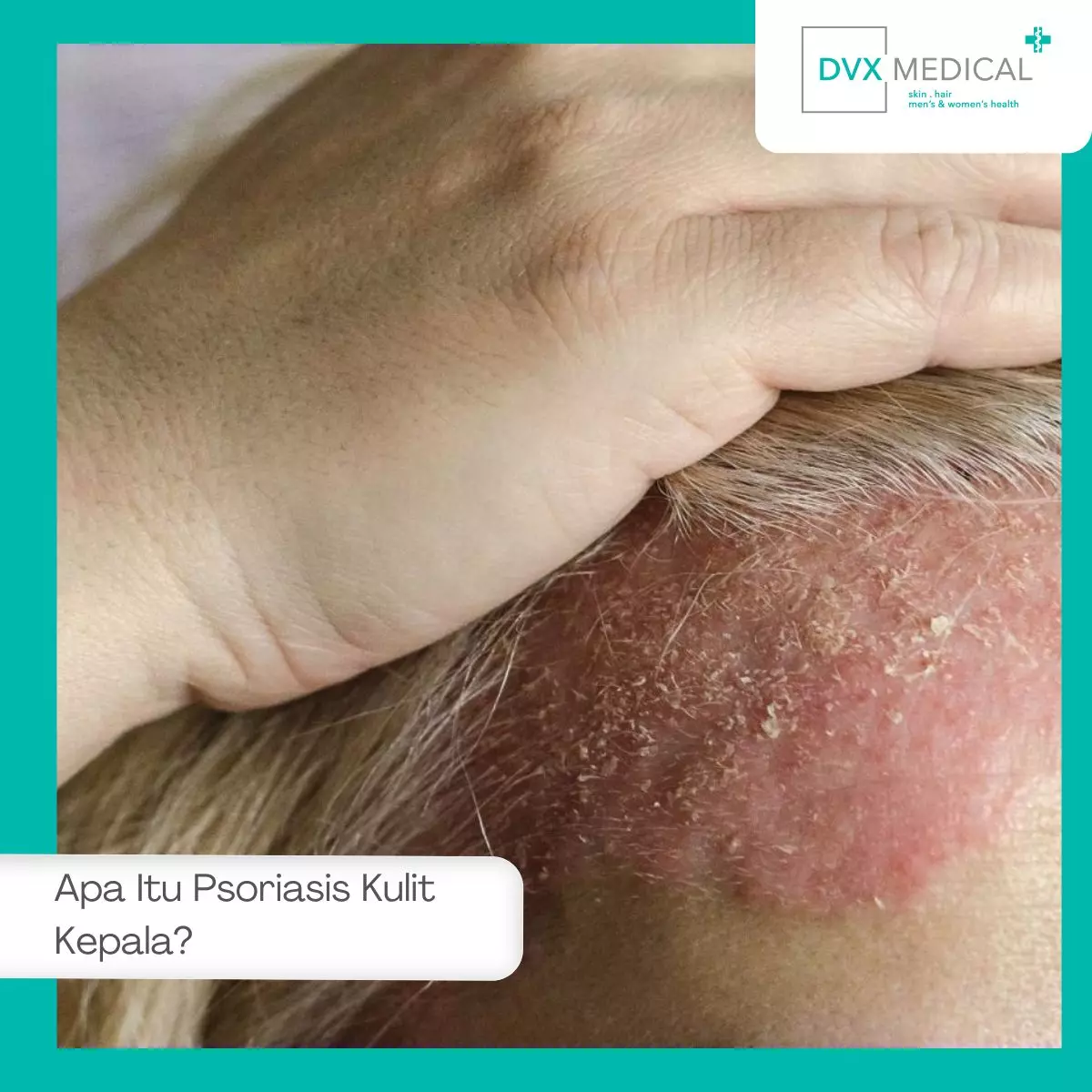 Apa Itu Psoriasis Kulit Kepala?