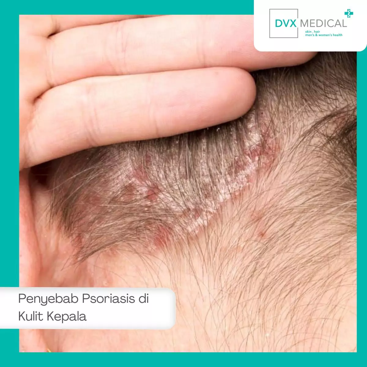 Penyebab Psoriasis di Kulit Kepala