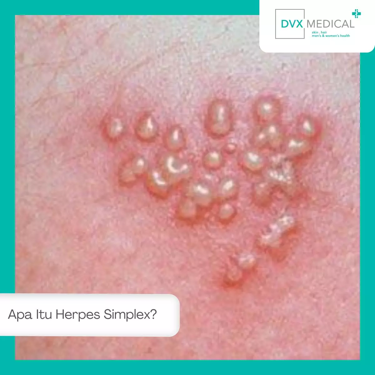 Apa Itu Herpes Simplex?