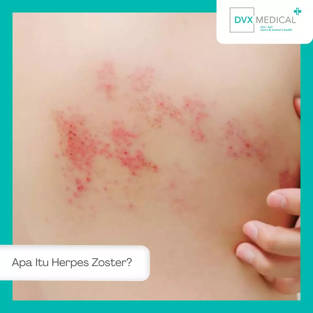 Apa Itu Herpes Zoster?