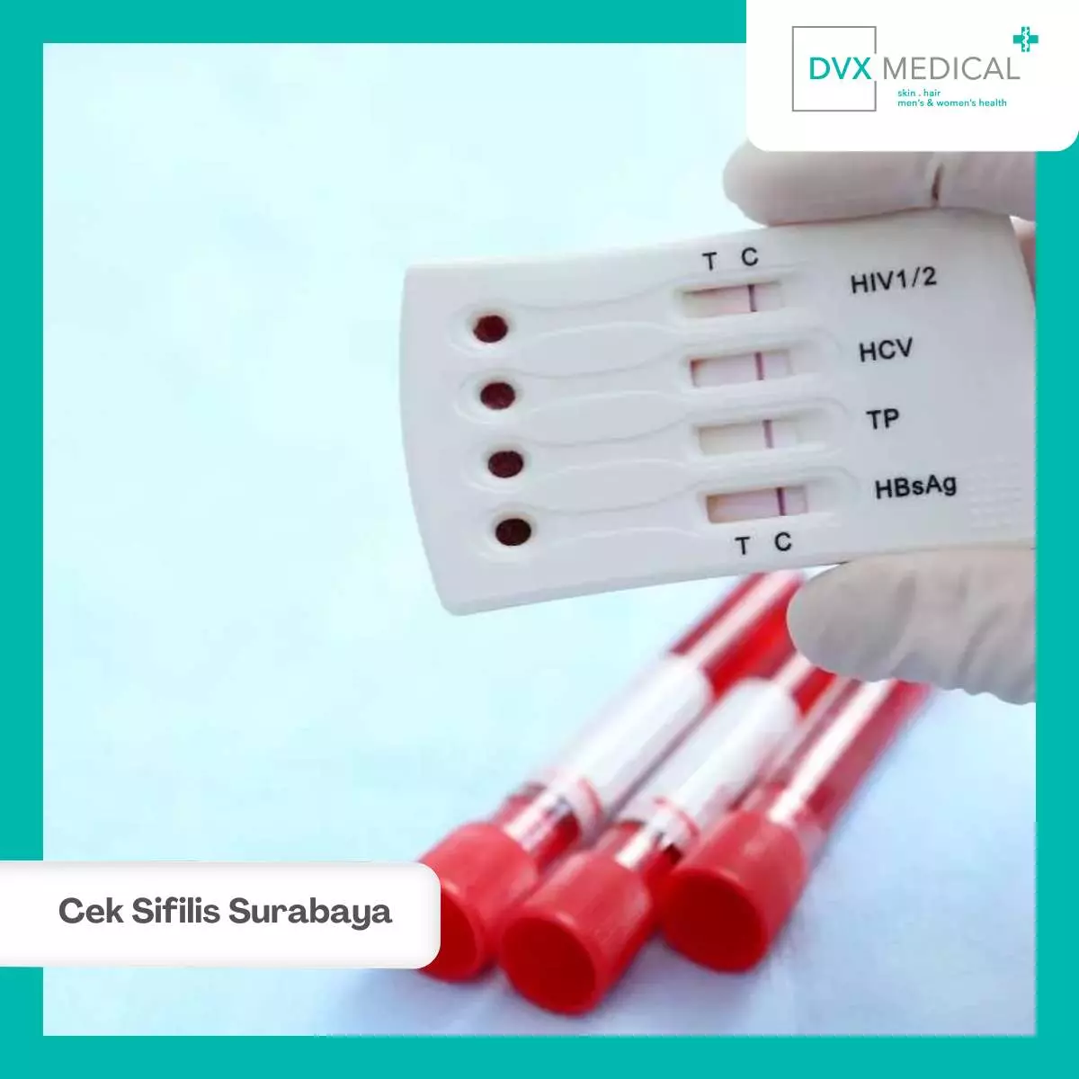 Pengobatan Sifilis di DVX Medical Surabaya