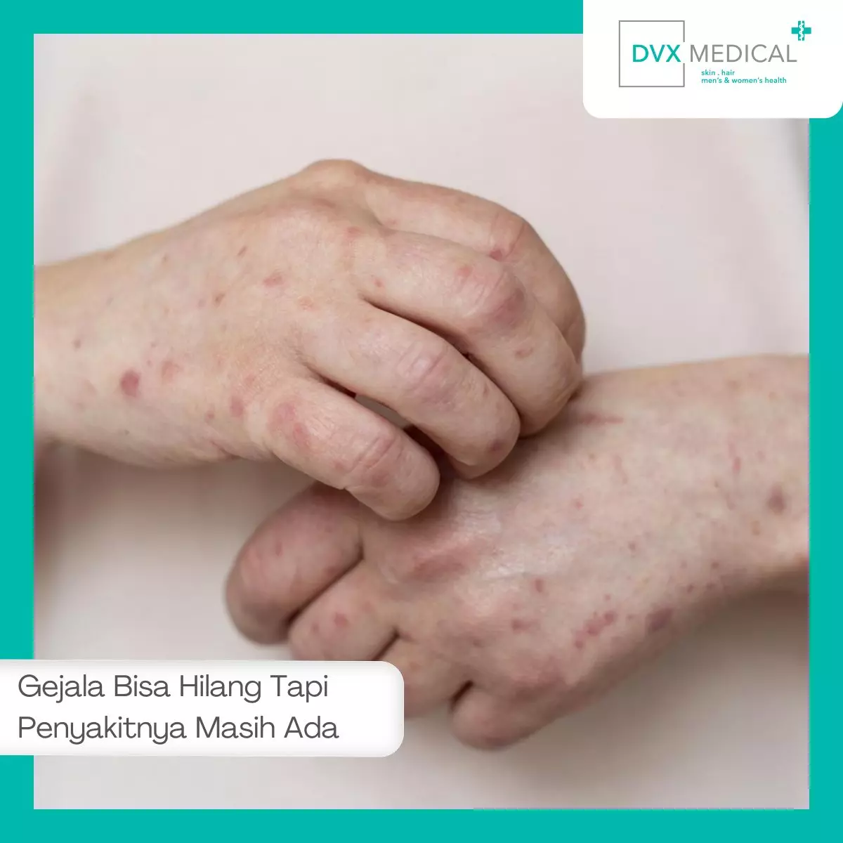 Mengapa Gejala Bisa Hilang Tapi Penyakitnya Masih Ada?