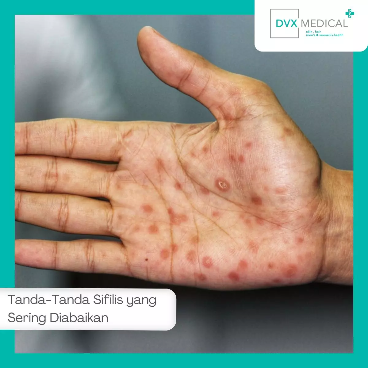 Tanda-Tanda Sifilis yang Sering Diabaikan