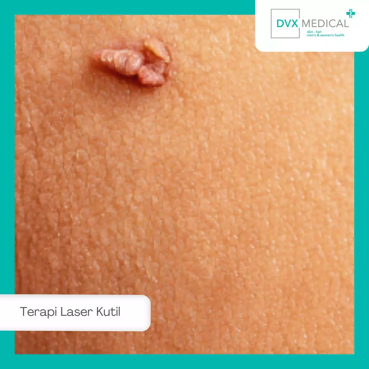 Terapi Laser dalam Pengobatan Kutil