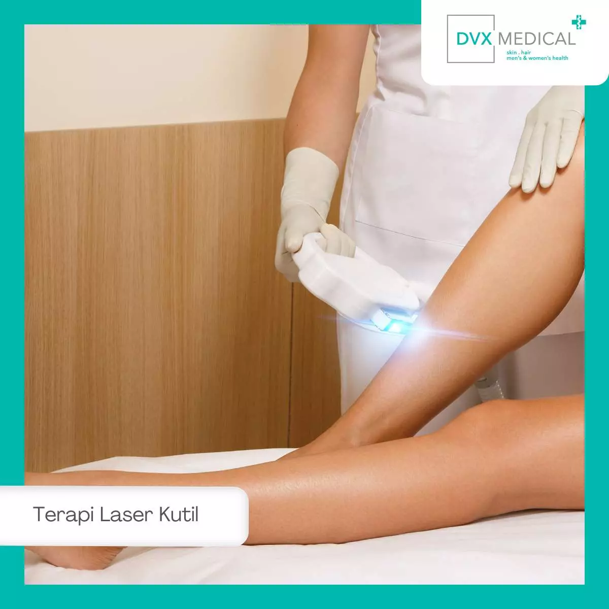 Keuntungan Terapi Laser untuk Menghilangkan Kutil