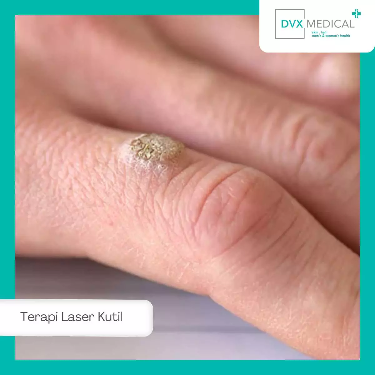 Perawatan Setelah Laser Kutil