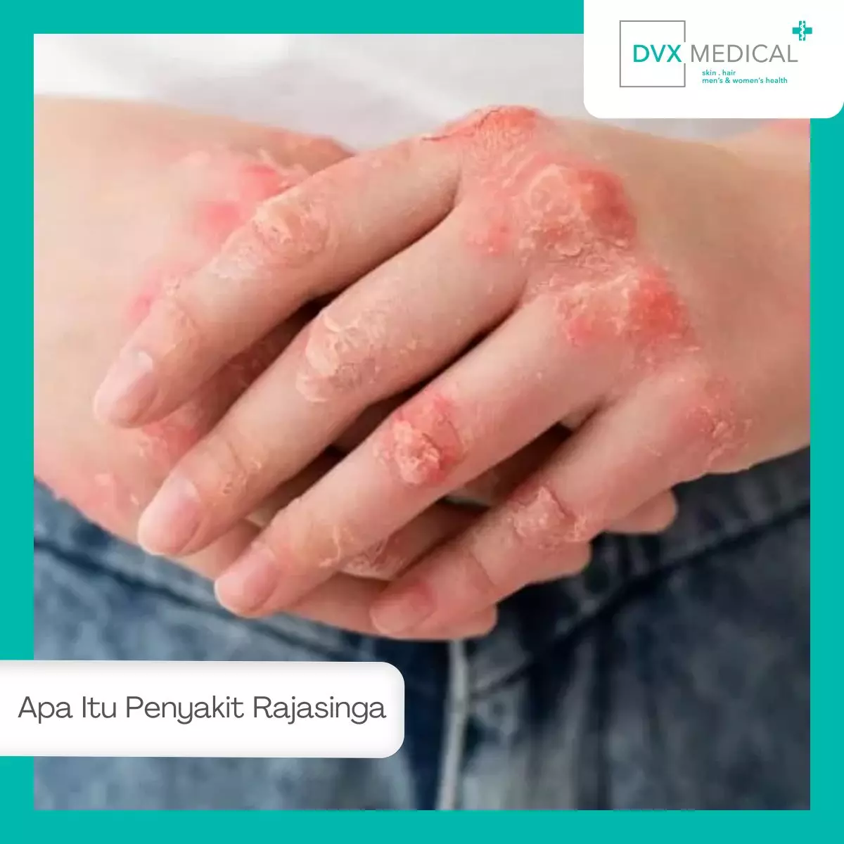 Apa Itu Penyakit Rajasinga