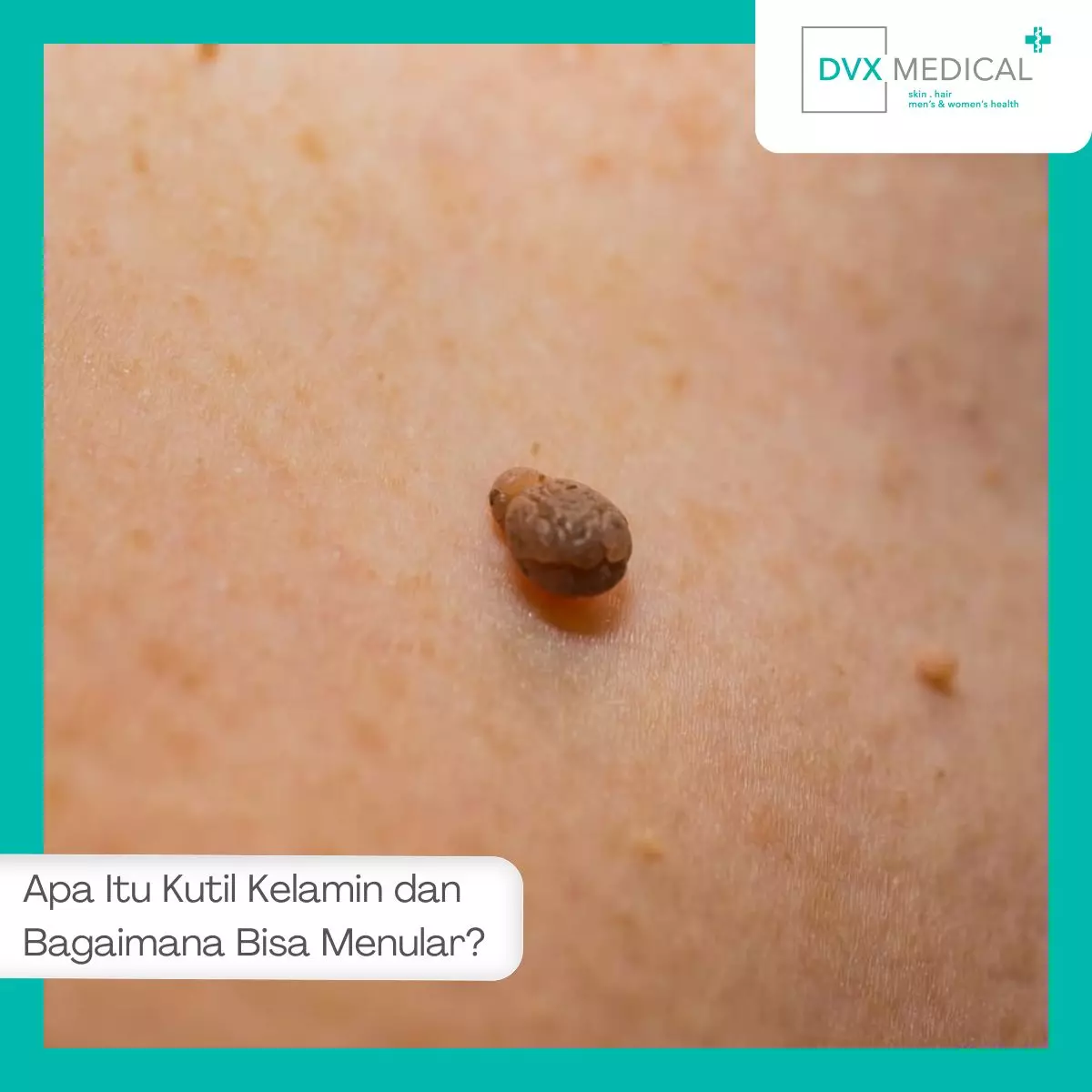 Apa Itu Kutil Kelamin dan Bagaimana Bisa Menular?