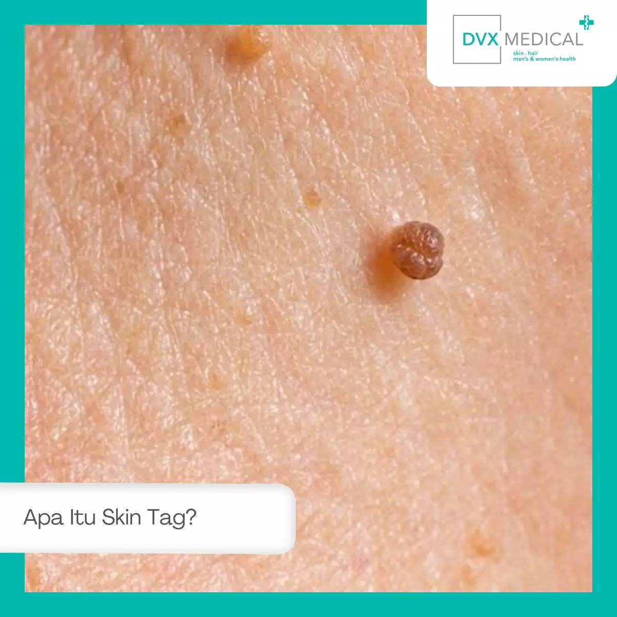 Apa Itu Skin Tag?