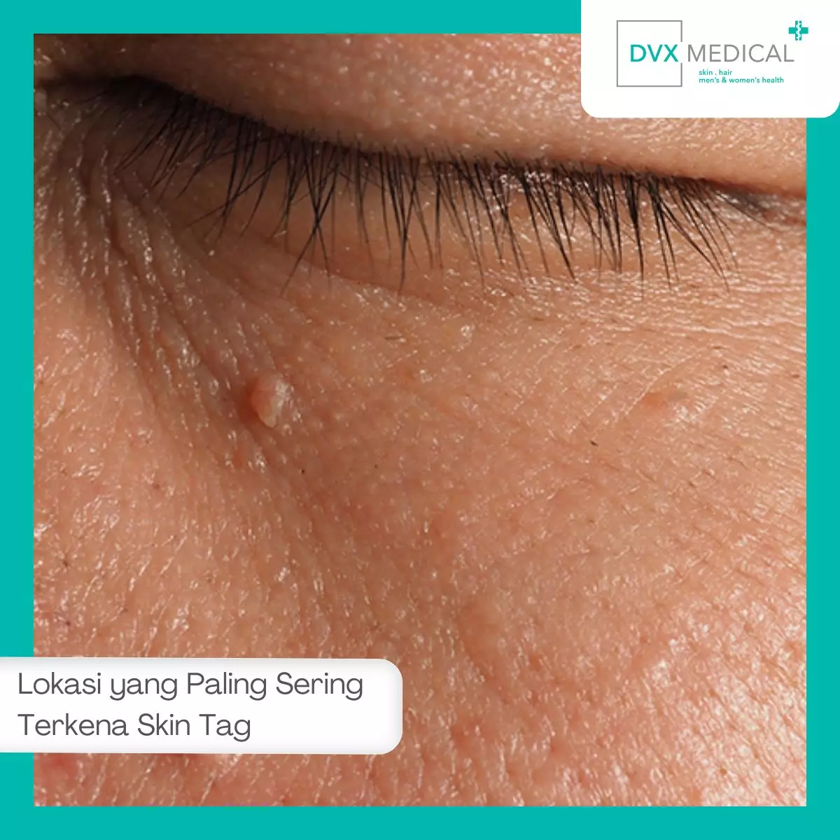 Lokasi yang Paling Sering Terkena Skin Tag