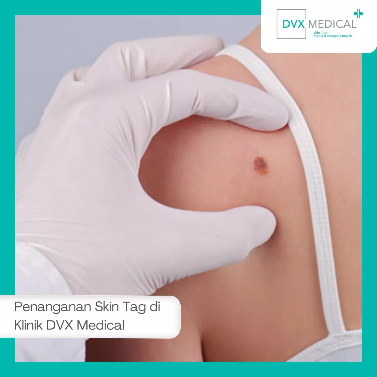 Penanganan Skin Tag yang Aman di Klinik DVX Medical Jakarta