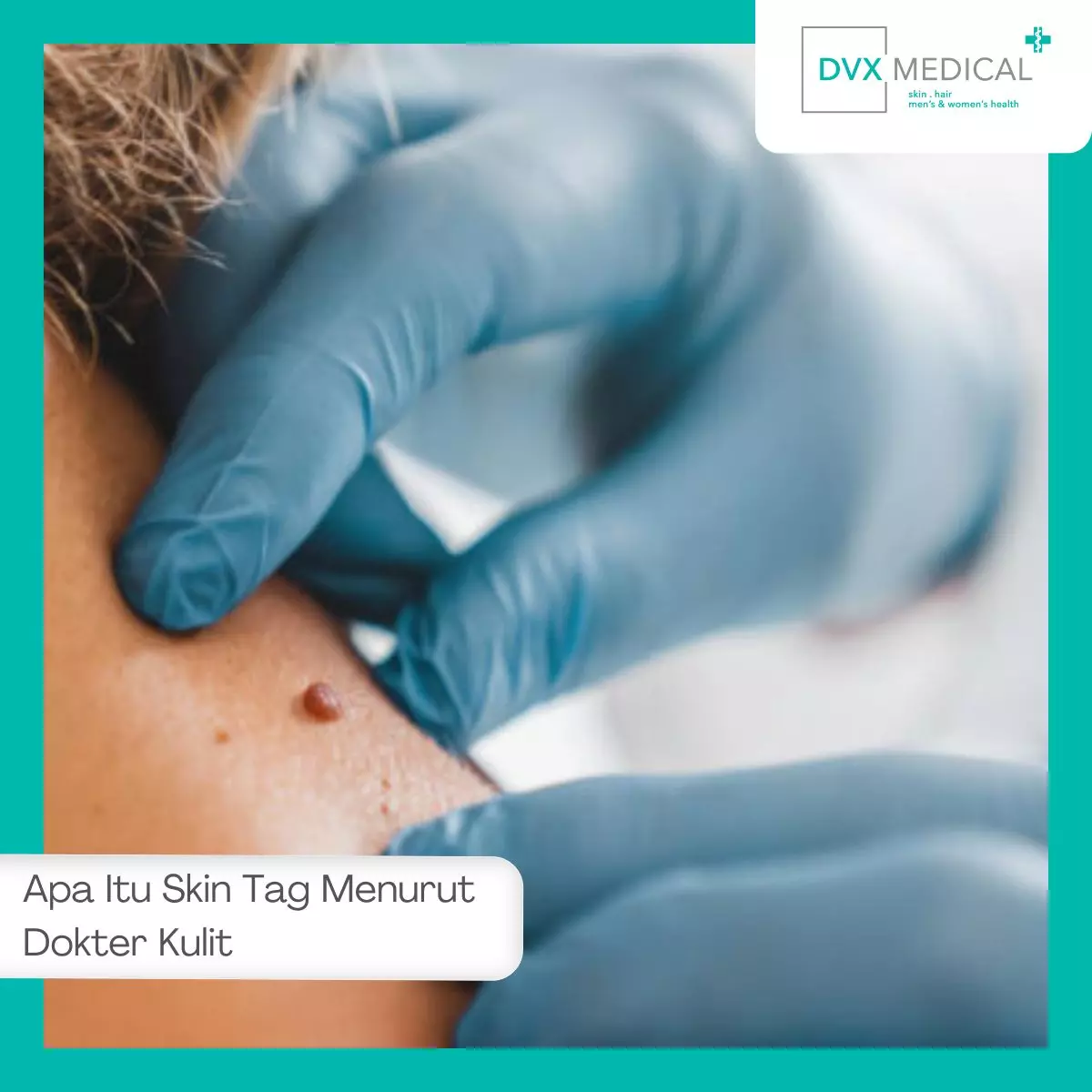 Apa Itu Skin Tag Menurut Dokter Kulit
