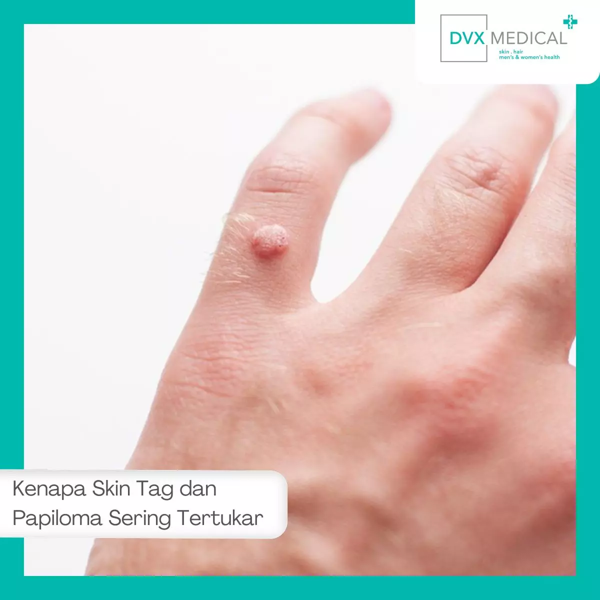 Kenapa Skin Tag dan Papiloma Sering Tertukar