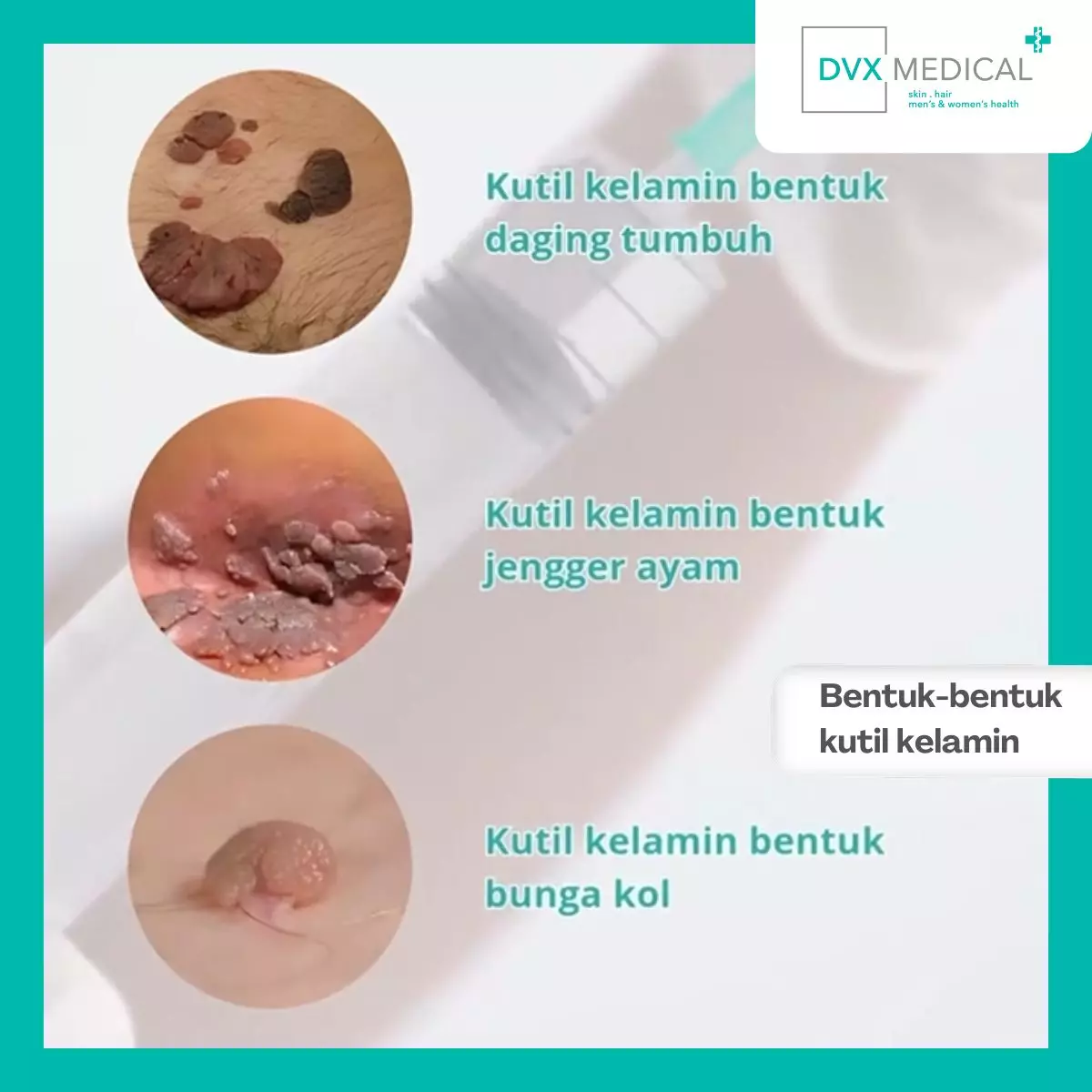 Bentuk-Bentuk Kutil Kelamin