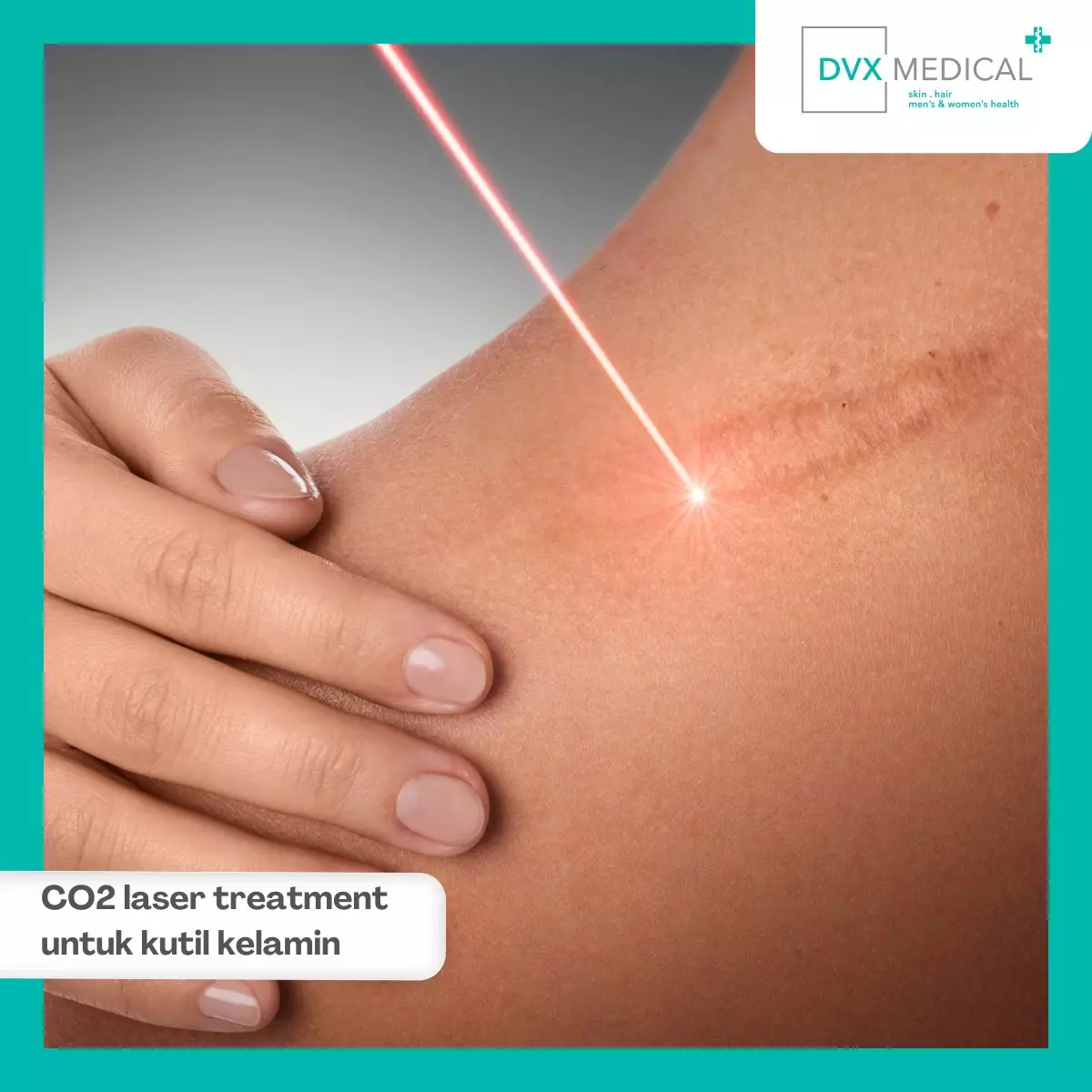 Hilangkan Kutil Kelamin dengan CO2 Laser Treatment di DVX Medical