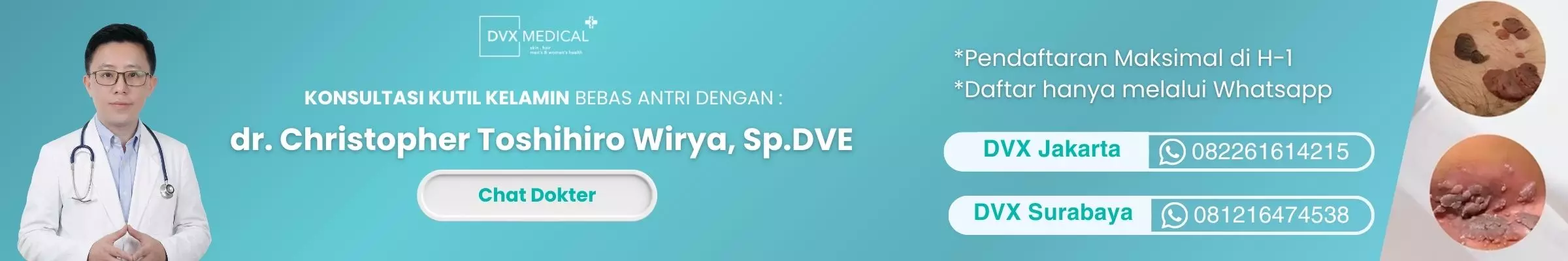 Kontak Dokter Spesialis Kutil Kelamin