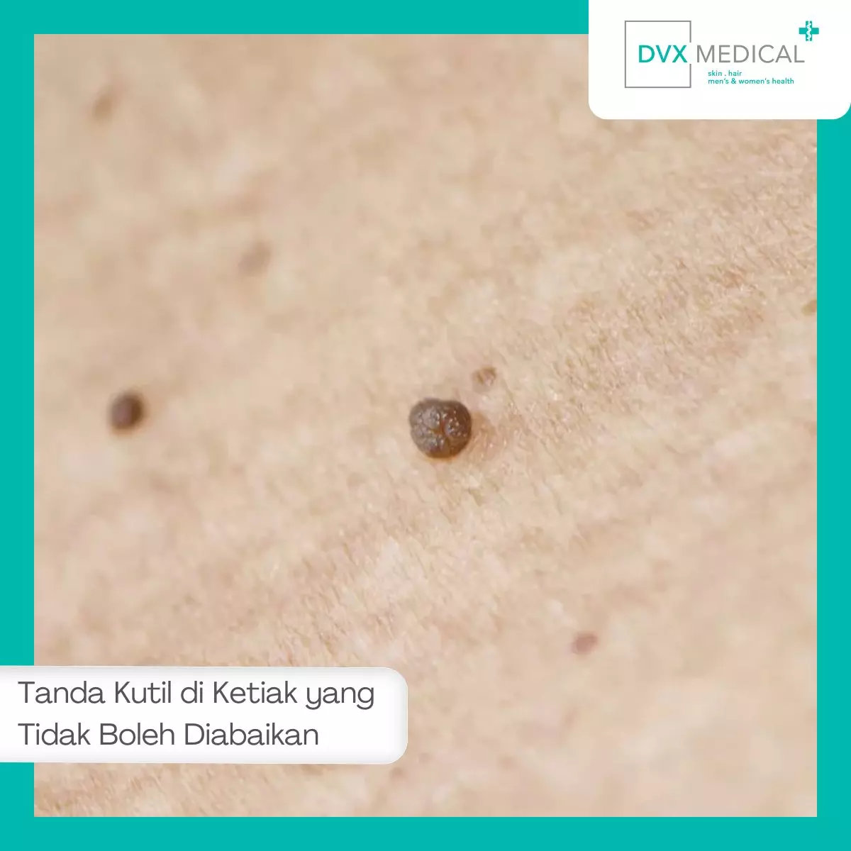 Tanda Kutil di Ketiak yang Tidak Boleh Diabaikan